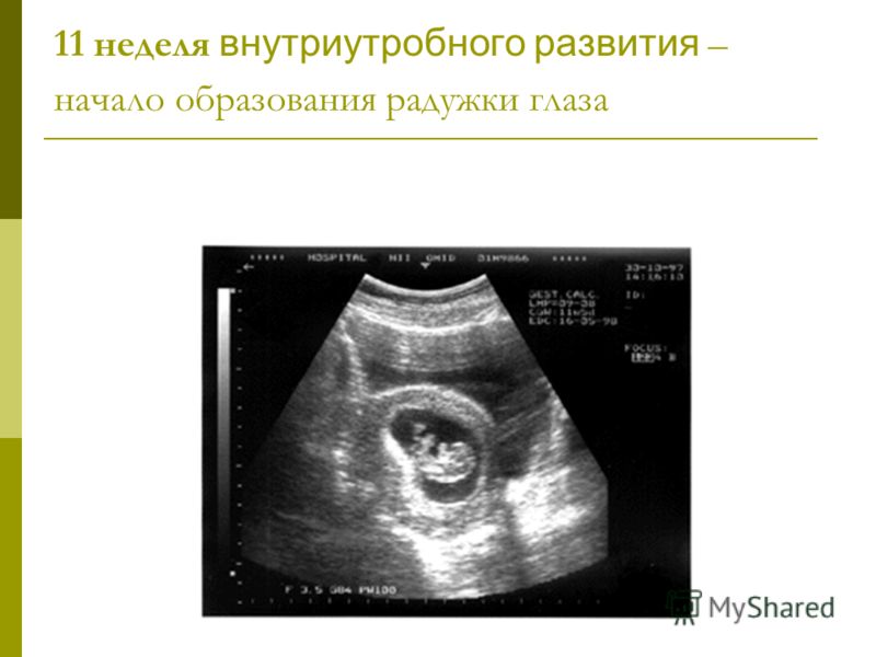 На узи видно внематочную. Внематочная беременность на УЗИ. Внематочная беременность УЗИ признаки. УЗИ при внематочной беременности на ранних сроках. 4 5 Недель беременности УЗИ внематочная.
