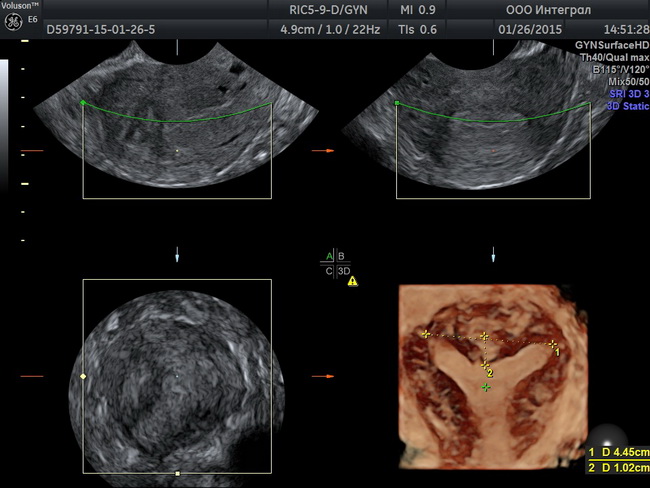 Снимки с УЗИ шейки матки
