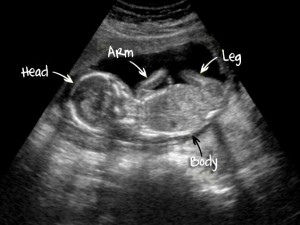 УЗИ снимок эмбриона на 15 неделе беременности