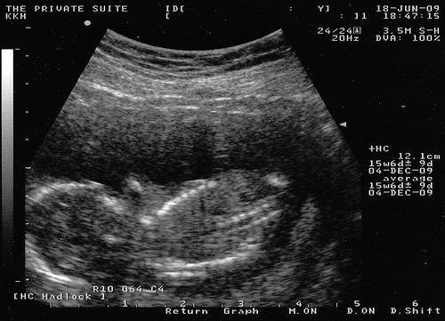 УЗИ 15 неделя беременности