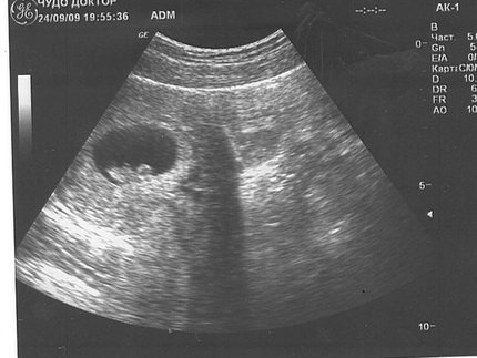 УЗИ беременной женщине на 2 неделе беременности