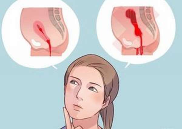 Кровотечения после аборта