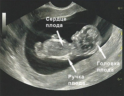 УЗИ плода на 11 неделе беременности
