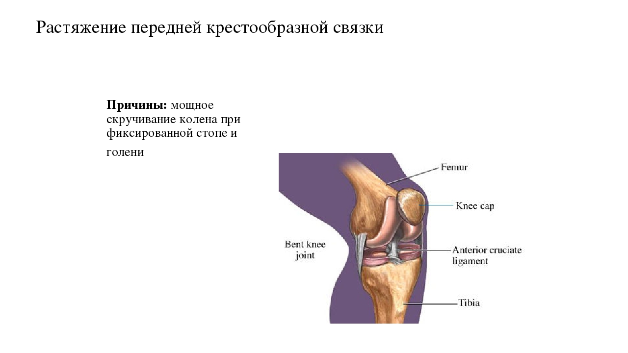 Растяжение коленных связок. Разрыв крестообразной связки на УЗИ. Растяжение передней крестообразной связки. Растяжение и разрыв передней крестообразной связки. Передняя крестообразная связка коленного сустава УЗИ.