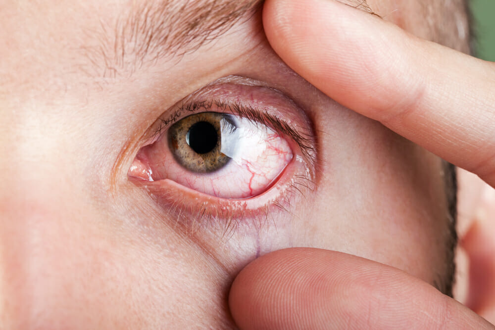 Глазные клещи у человека симптомы лечение