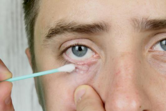 Лечение глазного клеща у человека