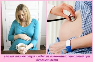 Признаки низкой плацентации при беременности