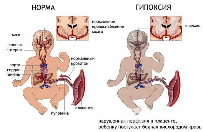 гипоксия головного мозга у новорожденных признаки