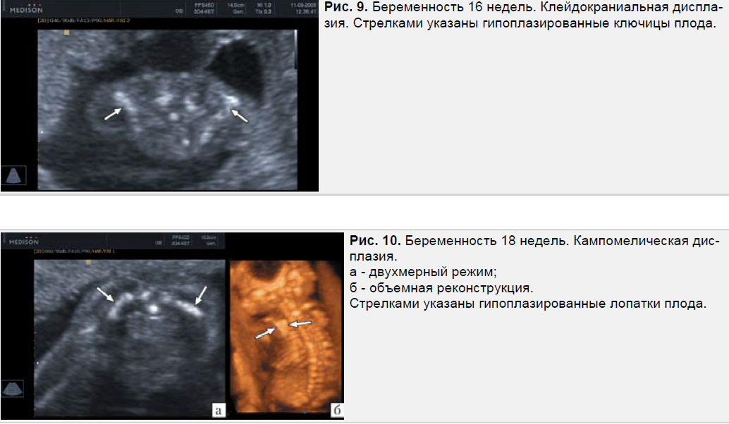 Узи 18. УЗИ 18 недель беременности нормы. УЗИ на 18 неделе беременности показатели.