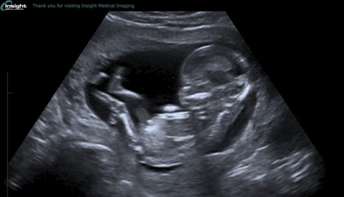 Норма плода 13 недель. Ребенок на 13 неделе беременности УЗИ. Снимок УЗИ на 13 неделе беременности. 13 Недель беременности фото плода на УЗИ. Размер эмбриона 13 недель.