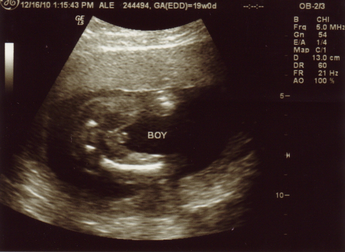 18 недель мальчик. Мальчик и девочка на УЗИ В 12 недель беременности. УЗИ 14 недель беременности пол ребенка девочка. 16 Недель беременности как выглядит ребенок на УЗИ. УЗИ беременности 16-17 недель мальчик.