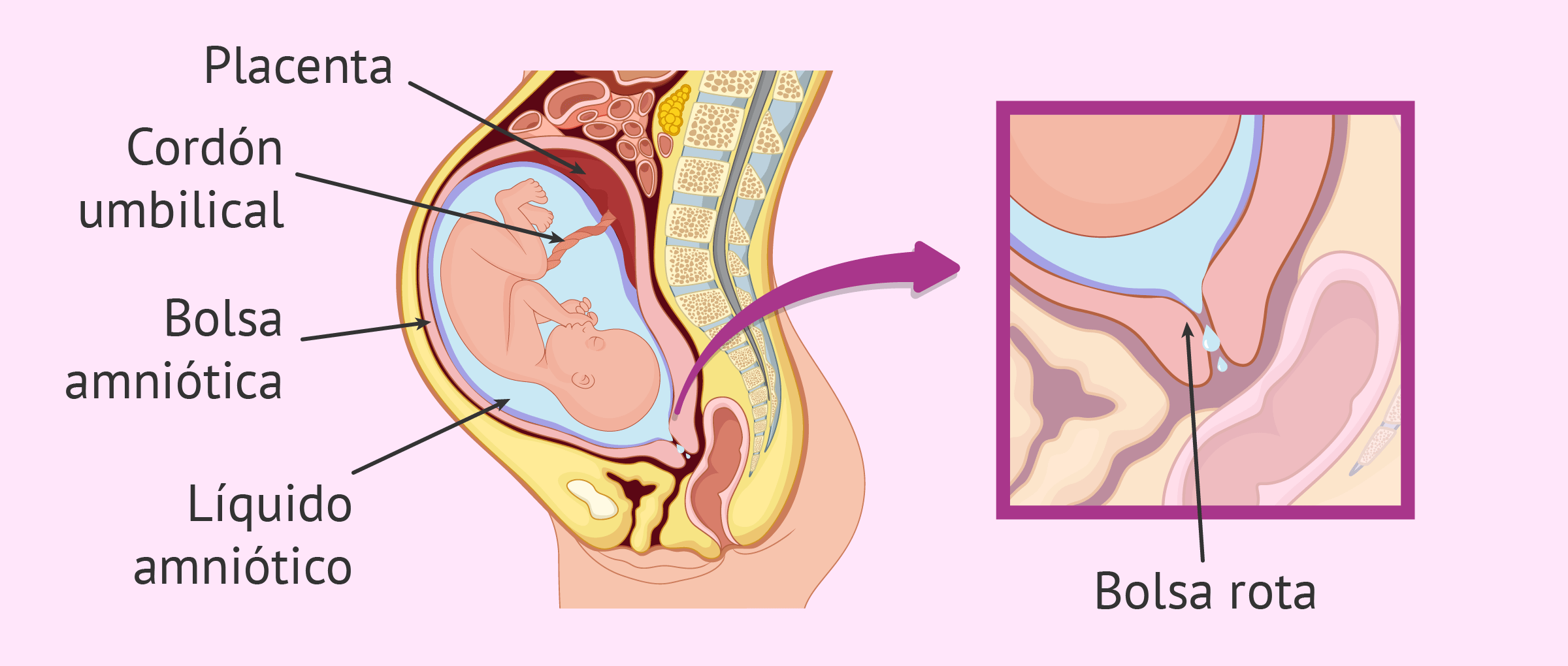 Acumulacion de liquido en el vientre