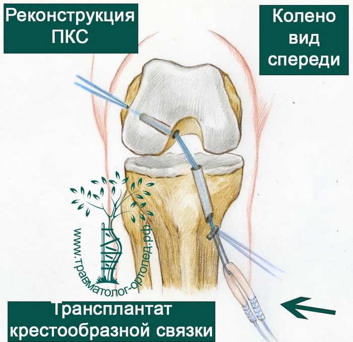 Операция по восстановлению коленного сустава. Разрыв связок ПКС коленного сустава. Повреждение крестообразной связки колена. Крестообразные связки коленного сустава схема. Разрыв связок коленного сустава ПКС операция.